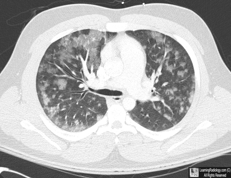 fat embolism